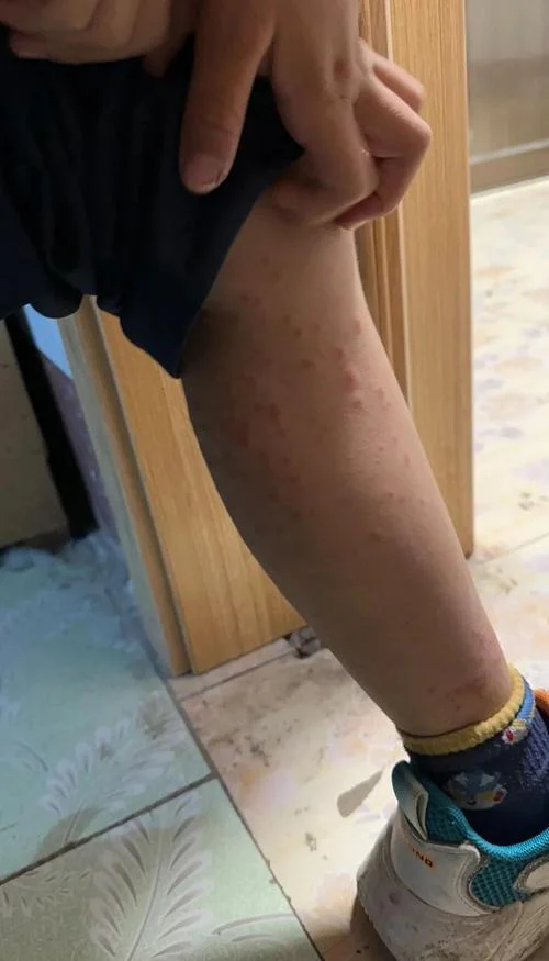 什么是紫癜性皮炎_1