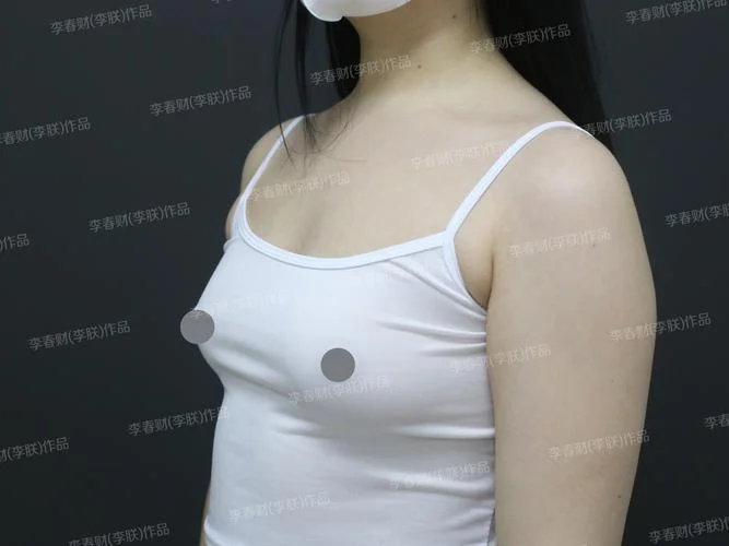 自体脂肪丰胸多少钱品质李朕_1