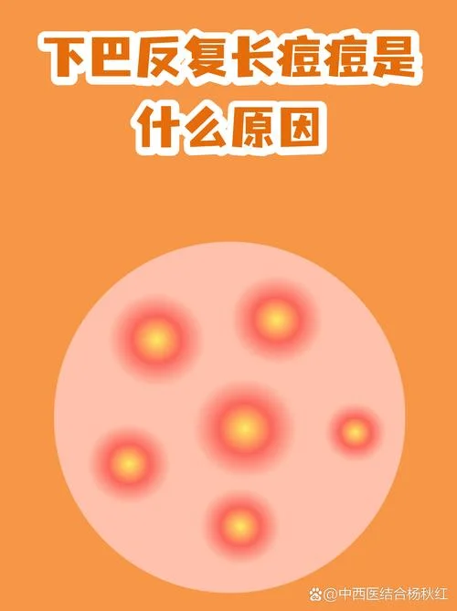 下巴爆痘是跟什么有关_1