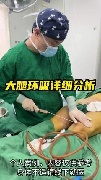 腿部吸脂整形手术多少钱_1