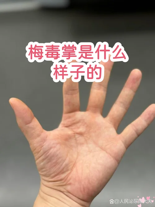 请问梅毒是什么意思_1