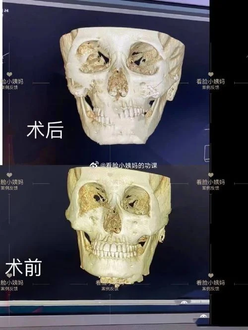 下颌角手术需要多少钱-下颌角手术报价参考