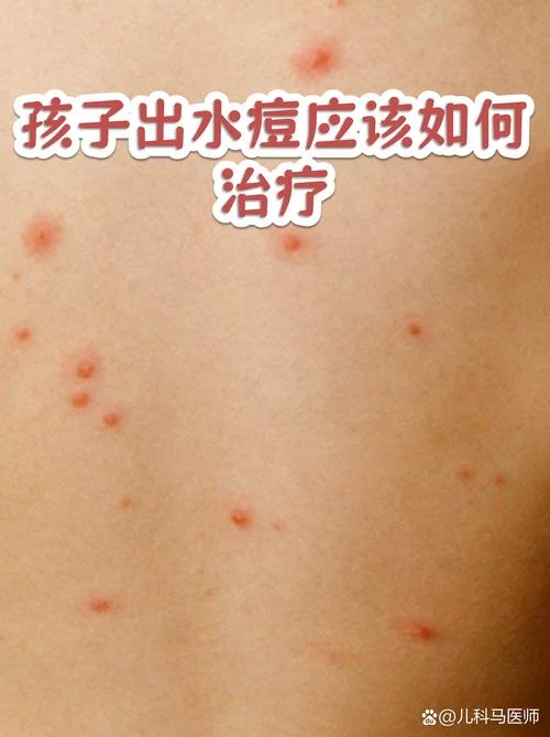 水痘是一种什么病_1