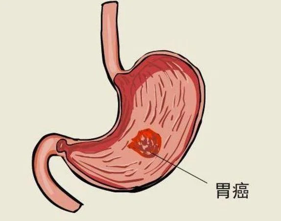 梦见自己得了胃癌晚期_1