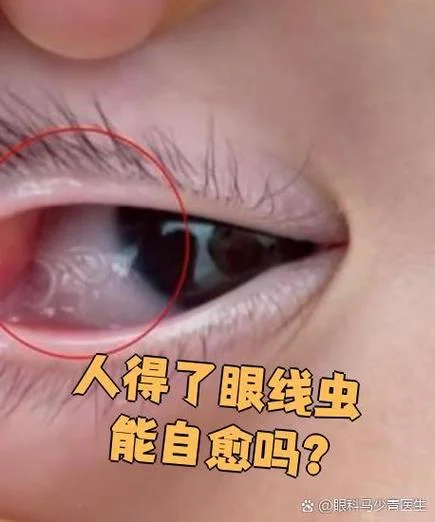梦见眼睛里有虫子_1