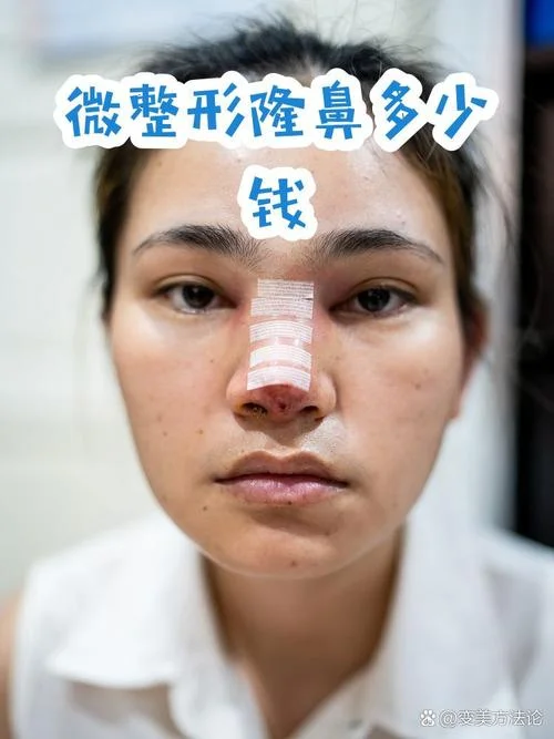 微整隆鼻多少钱_2
