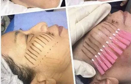 便秘埋线多少钱_2