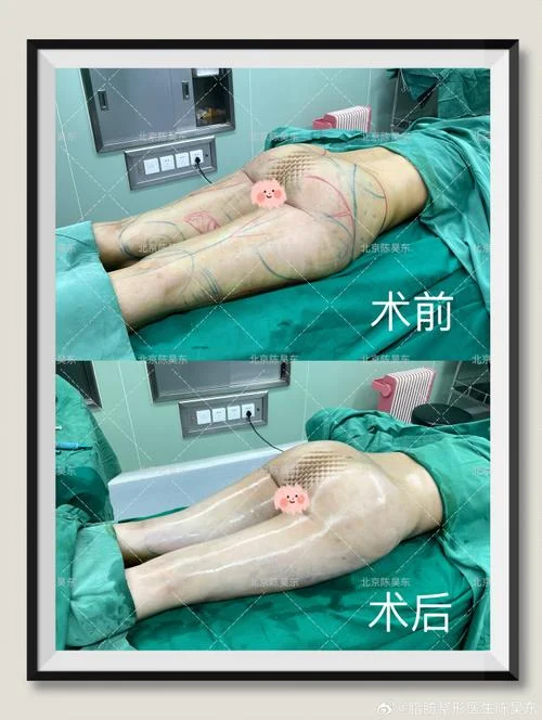 大腿部吸脂手术多少钱-大腿吸脂手术价格