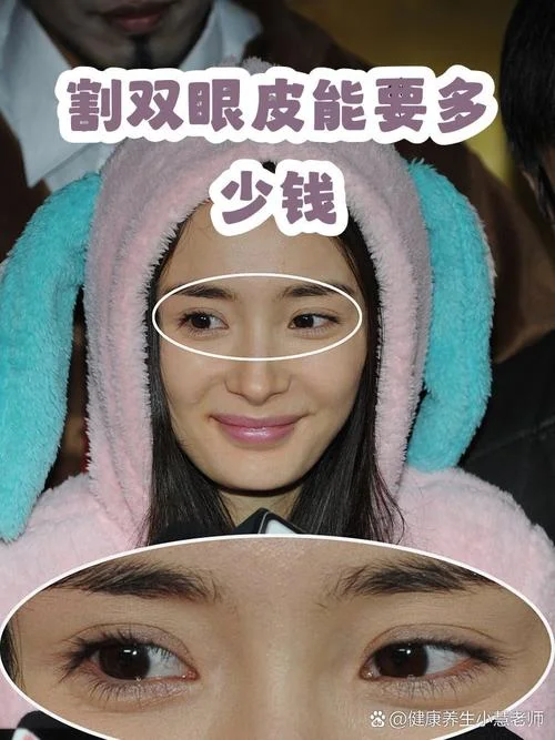 多少钱能个双眼皮修复_1