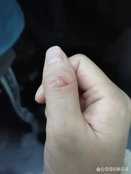 梦见白色老鼠咬手指头_2