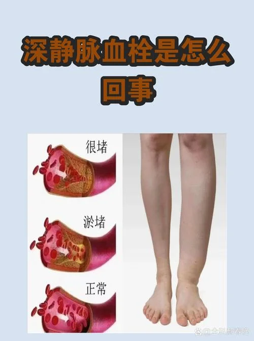 静脉血栓怎么办-静脉血栓怎么办