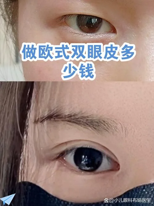 修复双眼皮要要多少钱_2