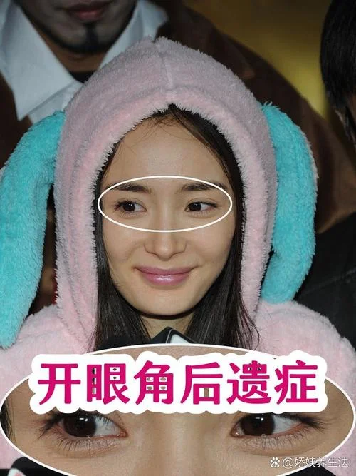开眼角2年了留疤怎么办-开眼角留疤怎么办