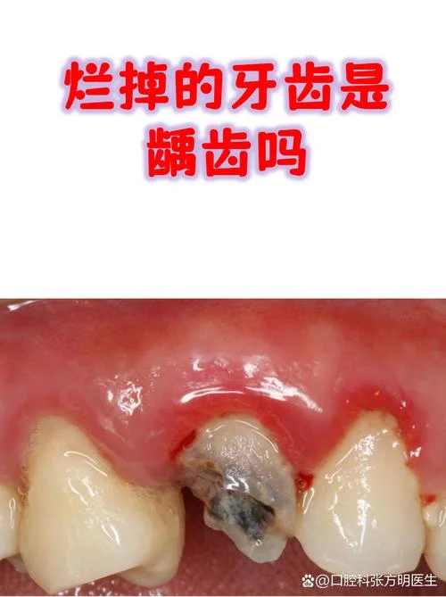 梦见牙疼有坏牙_2
