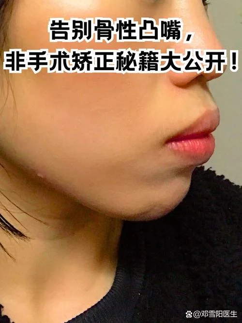 嘴部突出自我矫正_2