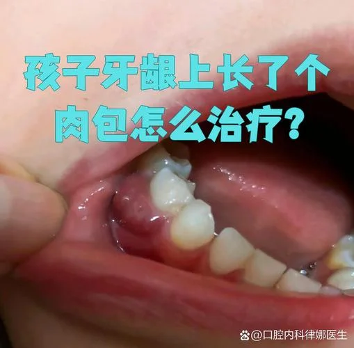 根尖囊肿一年会长多大-根尖囊肿一年长多少