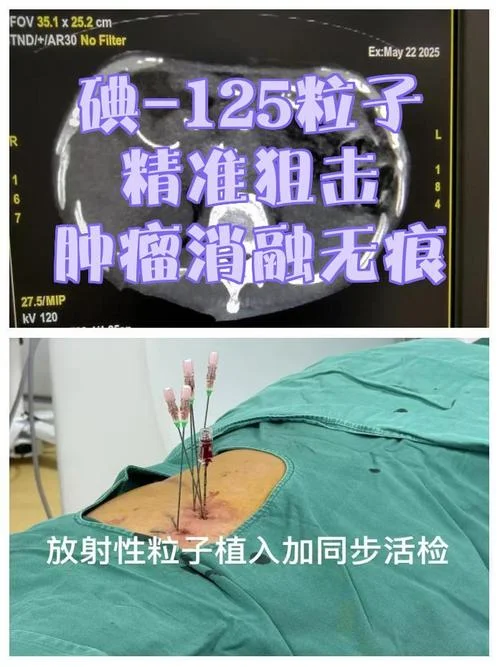 消融术大概费用多少钱_2