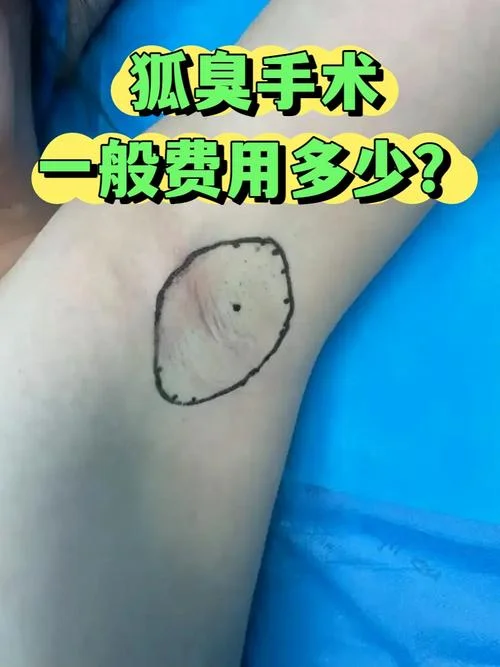 腋臭手术治疗大约多少钱_2