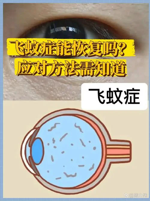 什么是飞蚊症得了飞蚊症怎么办-飞蚊症怎处理