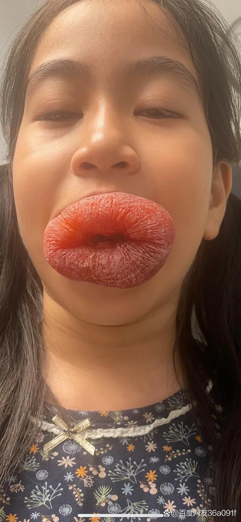 梦见嘴唇肿起来了_2