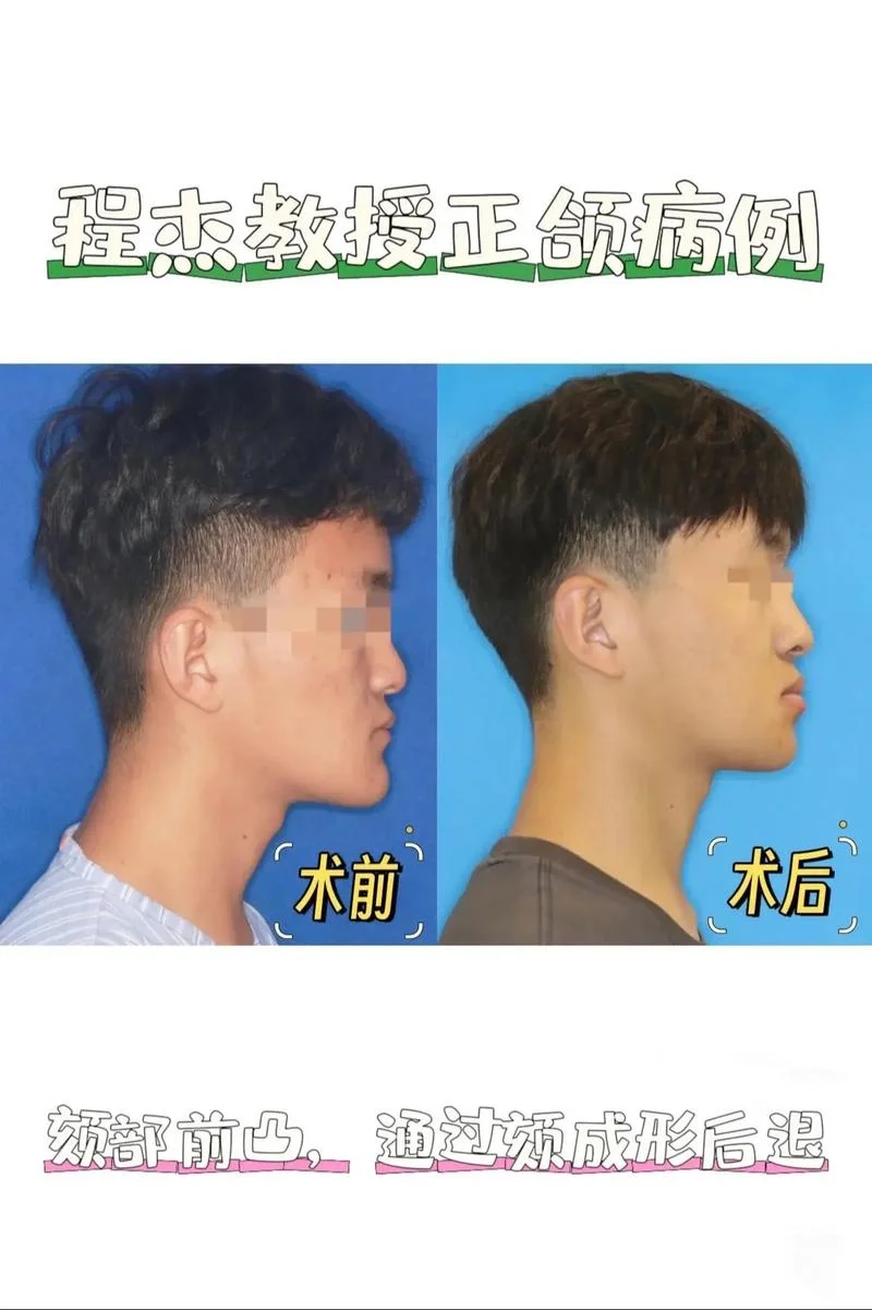 下颌骨向前突出面相_2