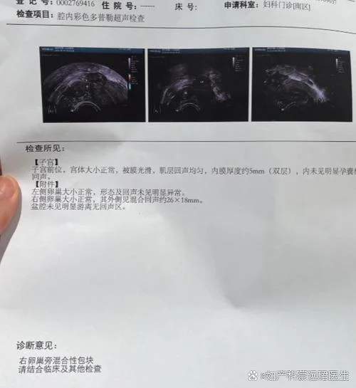 阴超显示回声不均匀什么意思_1