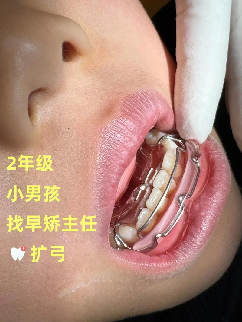 牙齿矫正一颗怎么做-牙齿矫正一颗怎么做
