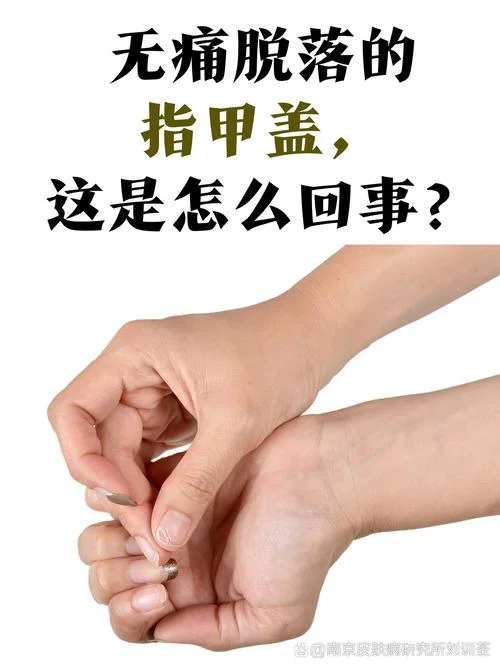 梦见右手指甲盖脱落_1