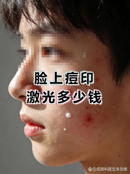 痘印治疗要多少钱_1