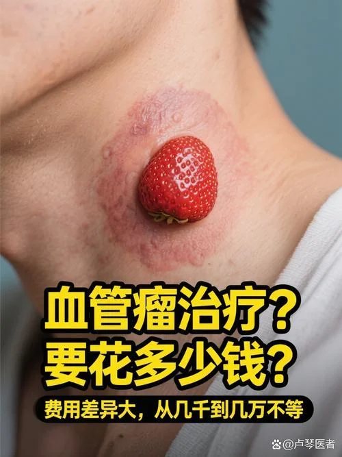 治疗血管瘤要多少钱_2