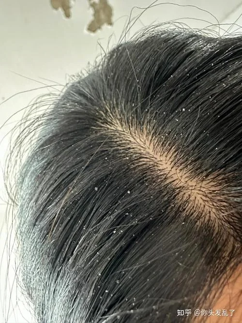 做梦头皮屑很大很多_1