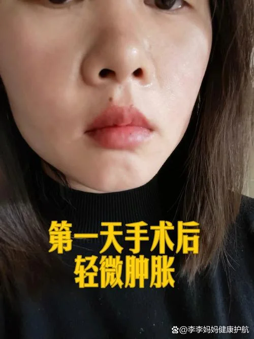 根尖囊肿一年会长多大_1