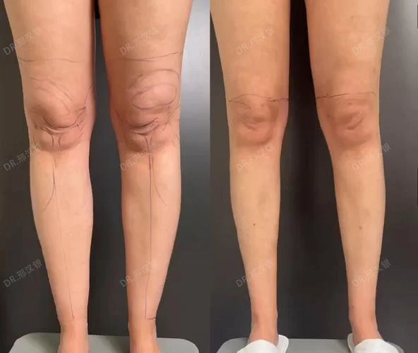 整条腿抽脂瘦腿话要多少钱_2
