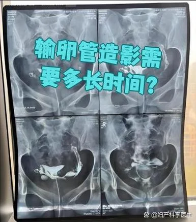 做个输卵管照影多少钱_1