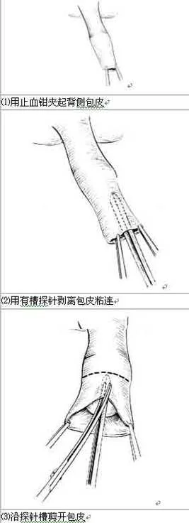 成人包茎修复术_2