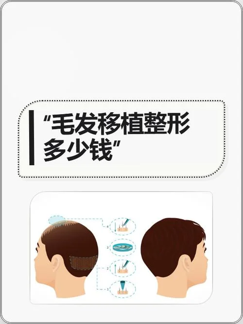 毛发移植要多少钱_1