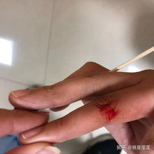 梦见被艾滋病人扎针_2