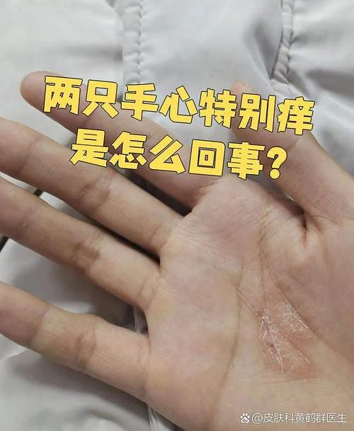 什么是鹅掌风图片-鹅掌风图片解析