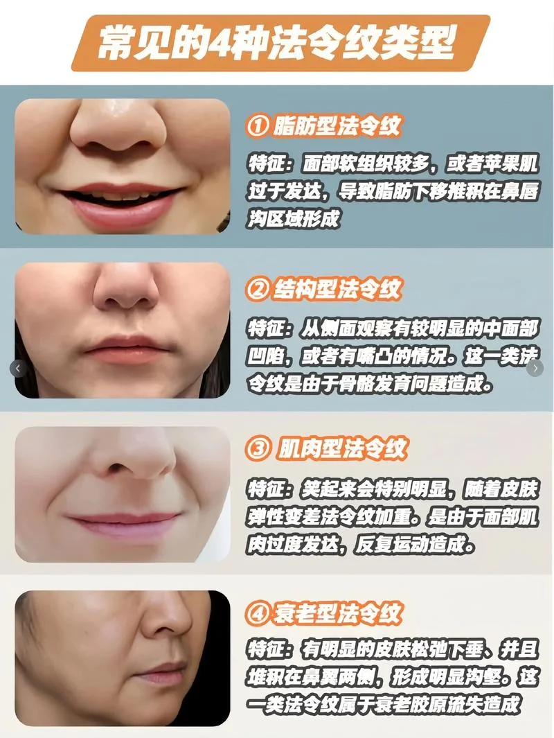 法令纹填充多少钱一针_1