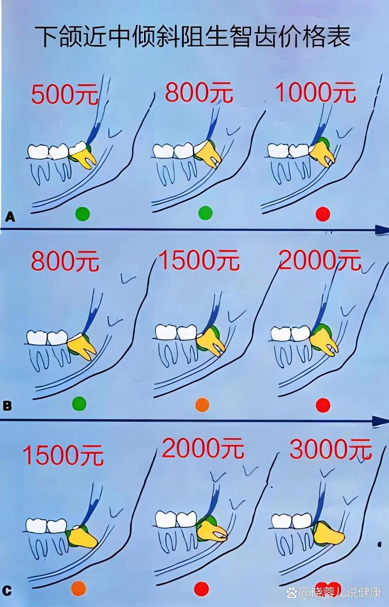拔阻生牙多少钱_1