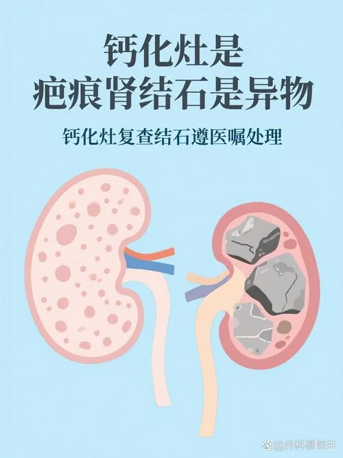 肾钙化灶是什么意思_1