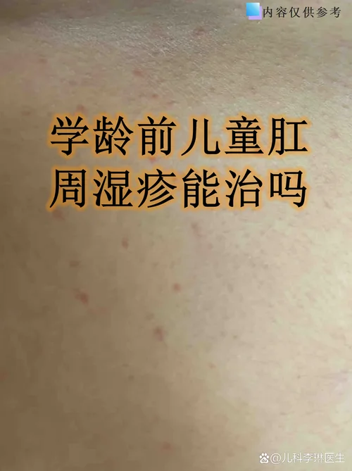 两岁宝宝肛门痒怎么办_1