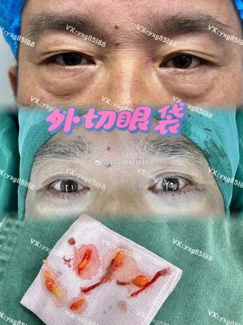 祛眼袋手术怎么做-祛眼袋手术详解