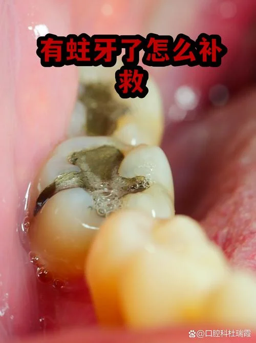 做梦蛀牙空了_1