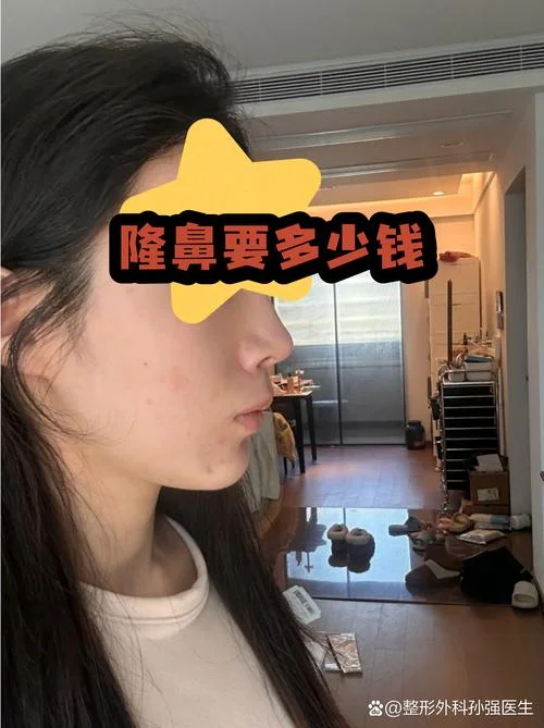 汕头注射隆鼻多少钱_1