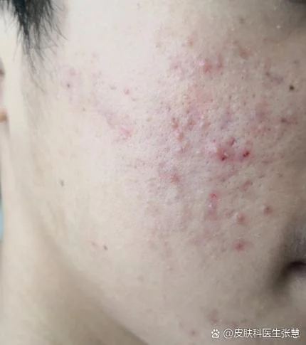 梦见面膜过敏脸上长痘_2