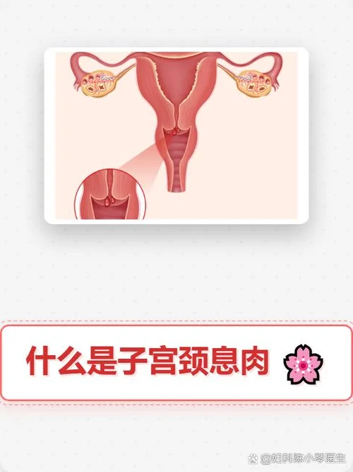 什么是子宫息肉样增生_1