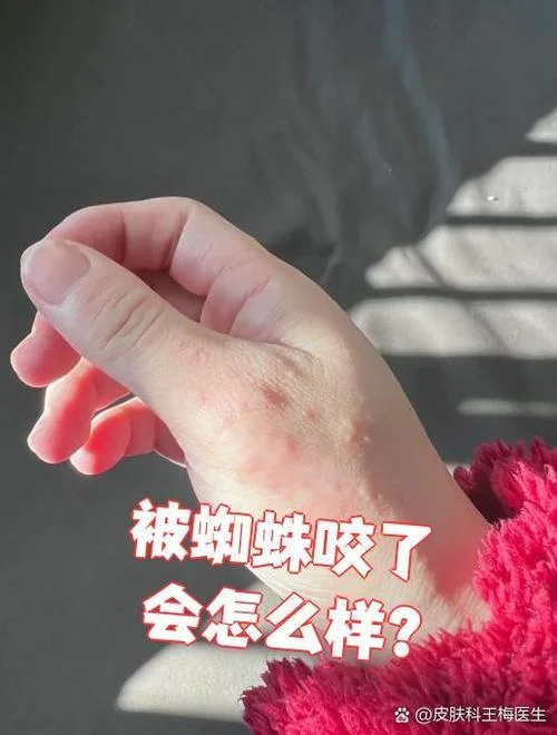 梦到被蜘蛛咬了手指_1