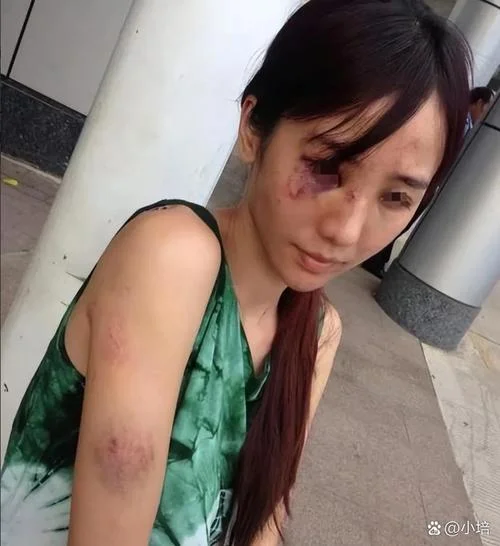 梦见自己被打伤_1