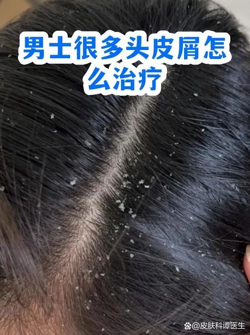 梦见头皮屑很多很大-梦见头皮屑硕多